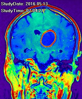 Thalamus Abszess