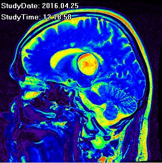 Hirnabszess am Thalamus
