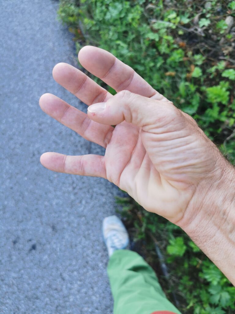 10 Jahre nach dem Hirnabszess, noch immer Spastik